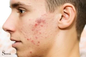 what is the spiritual meaning of acne